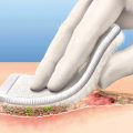 How to Remove Slough From Wounds Safely and Effectively