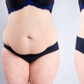 The Impact of Tummy Tuck Procedures on Patient Satisfaction