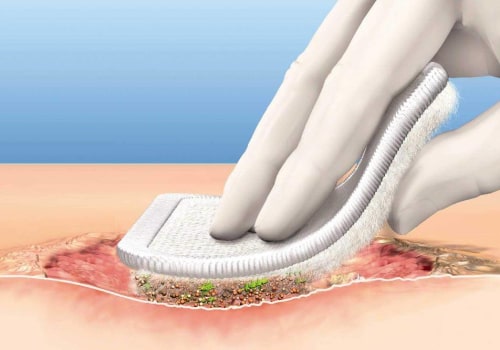 How to Remove Slough From Wounds Safely and Effectively